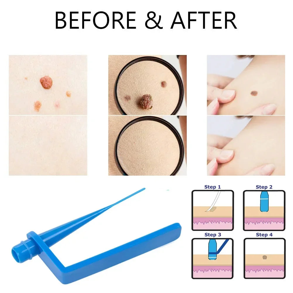 Skin Tag Remover Kit – Rubber Band Mole & Wart Removal Tool