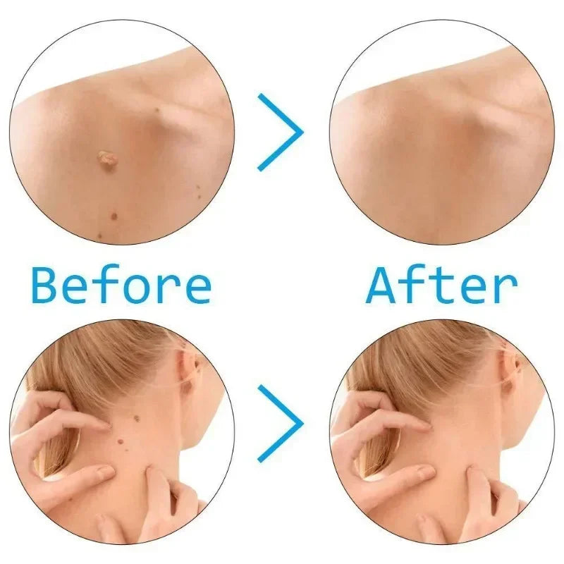 Skin Tag Remover Kit – Rubber Band Mole & Wart Removal Tool