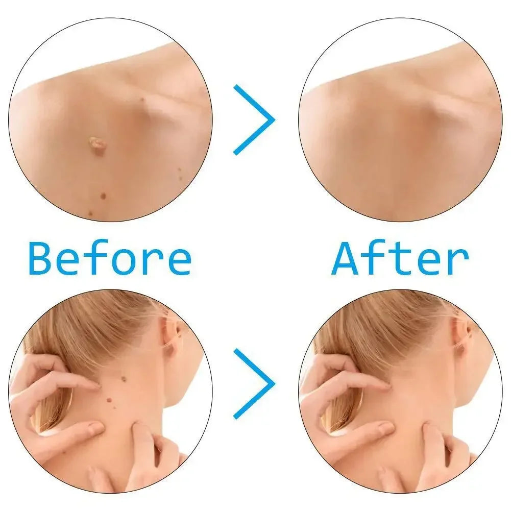 Skin Tag Remover Kit – Rubber Band Mole & Wart Removal Tool