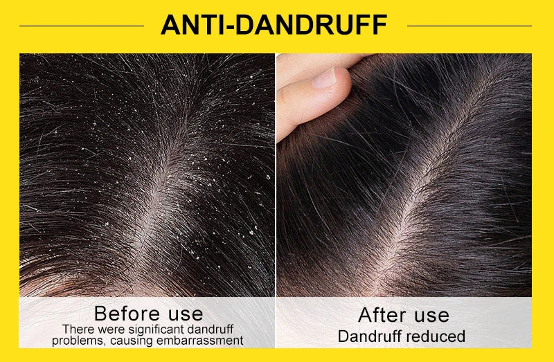 Rosemary & Ginger Hair Growth Mask – Anti Hair Loss