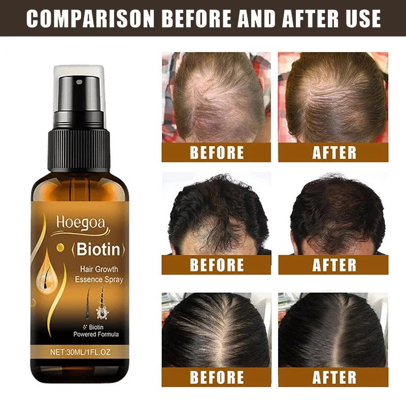 Biotin Fast Hair Growth Spray 30ml – Anti-Hair Loss & Baldness Treatment