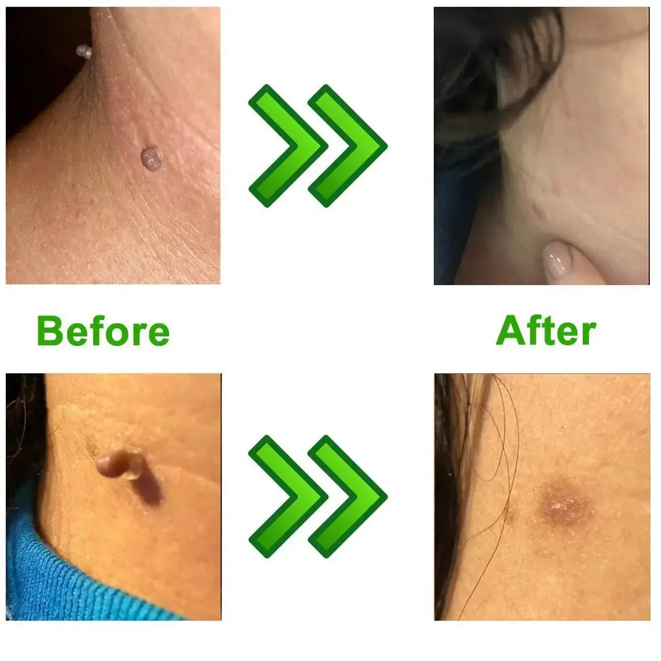 Skin Tag Remover Kit – Rubber Band Mole & Wart Removal Tool