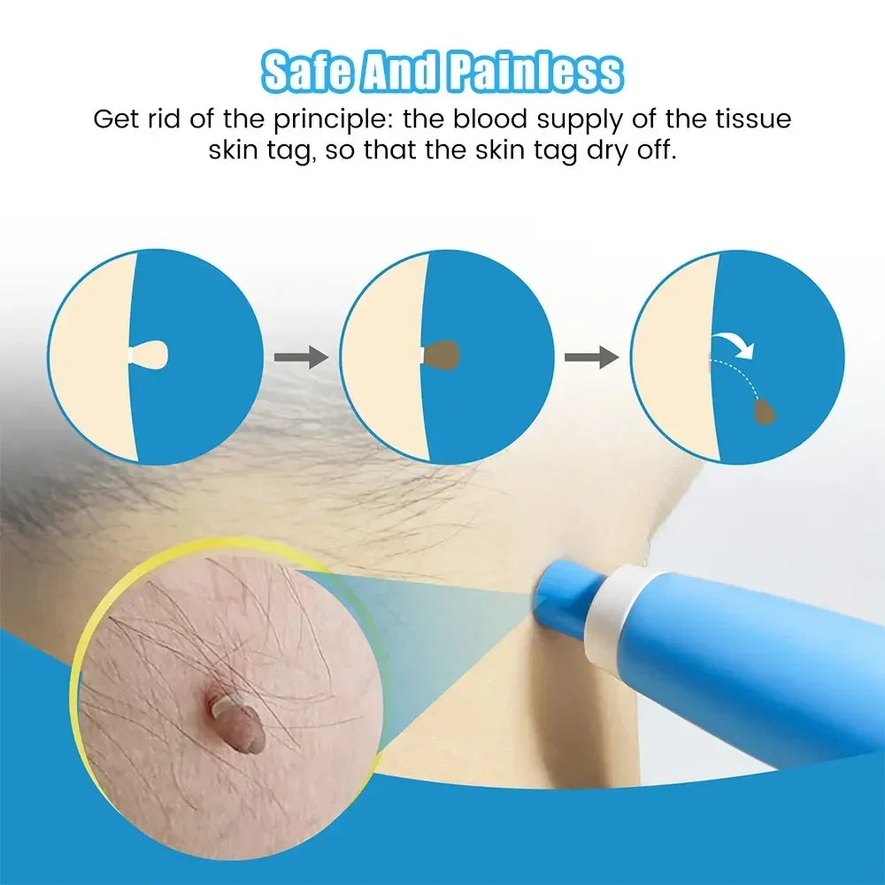 Skin Tag & Wart Remover Device Kit – 2-in-1 Auto Micro