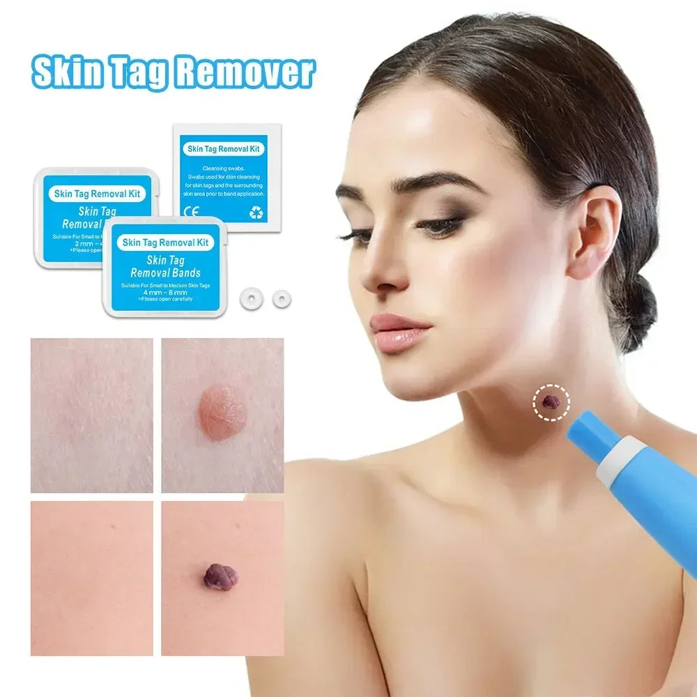 Skin Tag & Wart Remover Device Kit – 2-in-1 Auto Micro