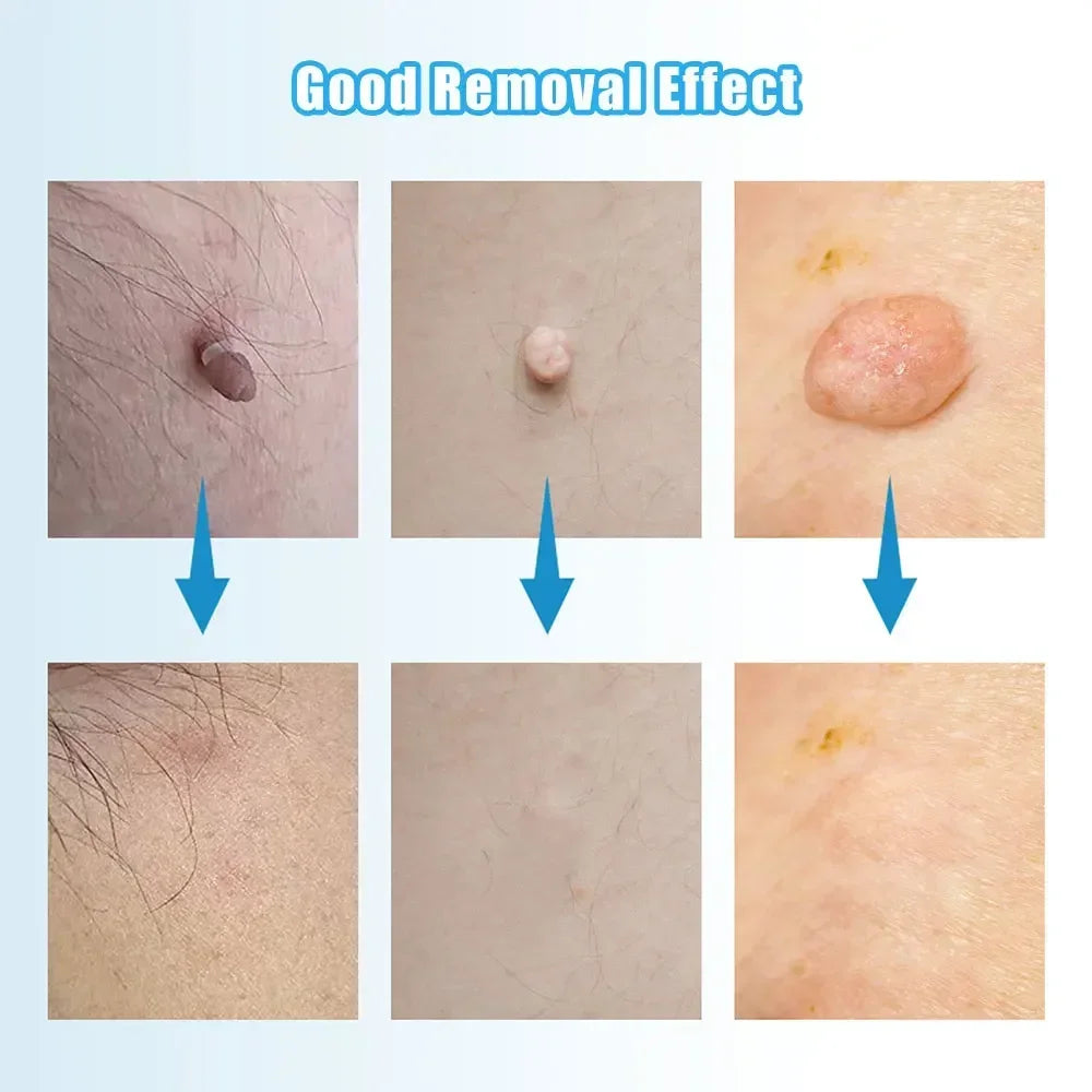 Skin Tag & Wart Remover Device Kit – 2-in-1 Auto Micro